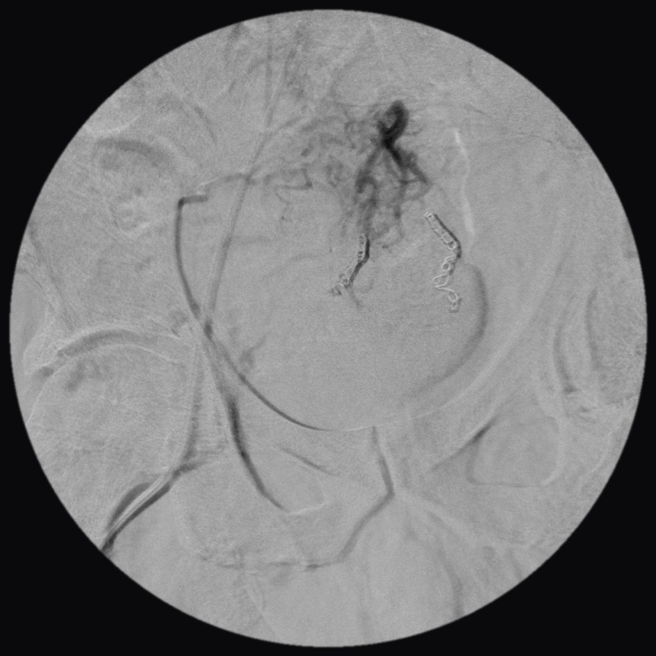 Angiogram after both branches were treated: a wider view of the pelvis with coils in place on both sides and no hemorrhoidal blush filling