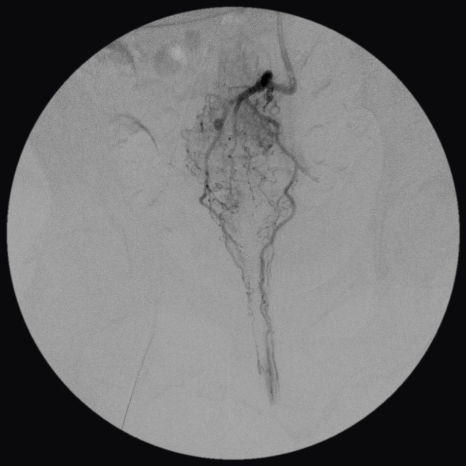 Angiogram before embolization: the left branch of the superior rectal artery, with a dense tangle of vessels feeding the hemorrhoids filling with dye