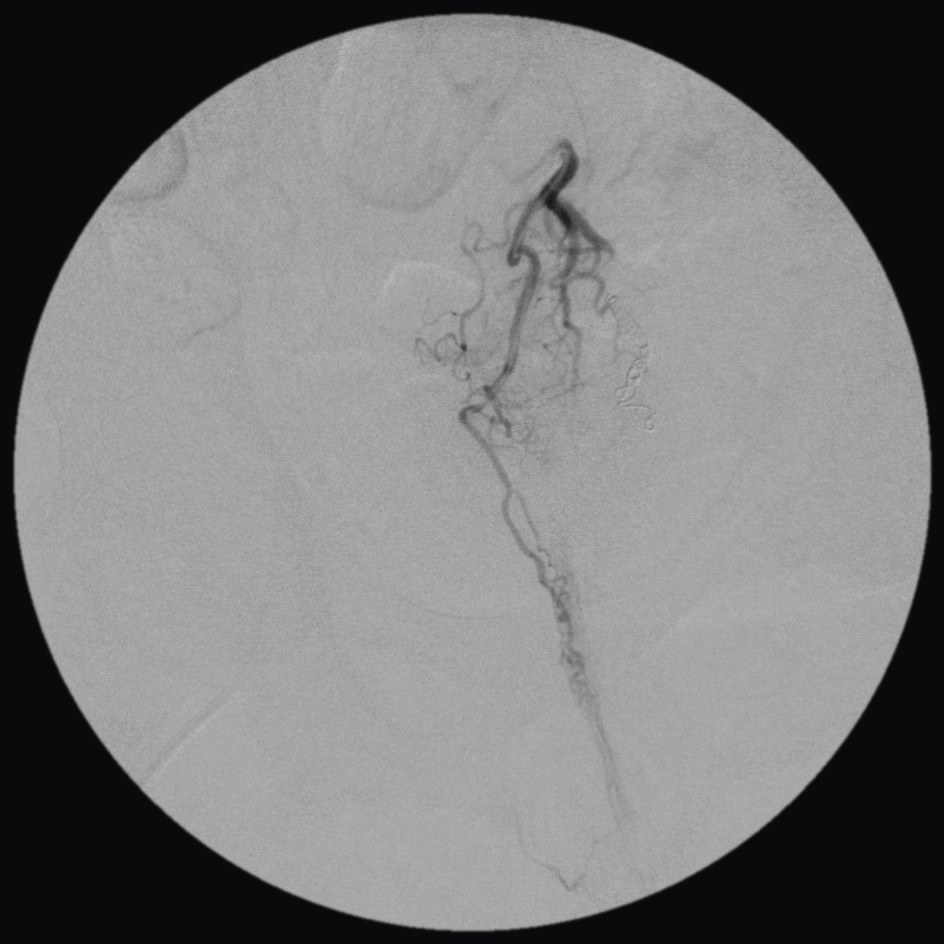 Angiogram before embolization: the right branch of the superior rectal artery in the same patient, with the tangle of hemorrhoidal vessels filling with dye