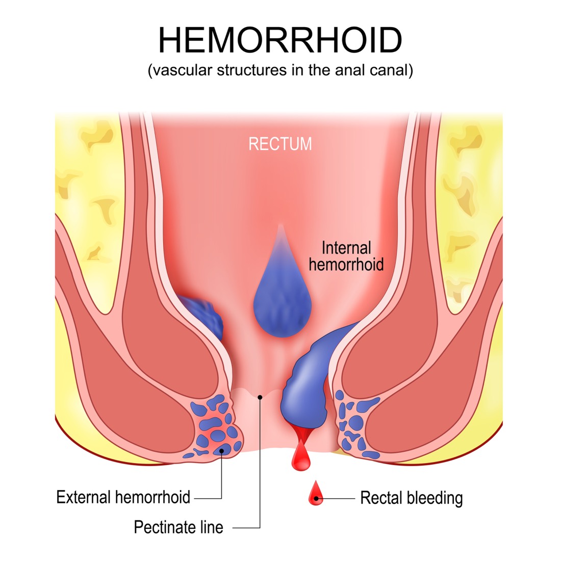 Diagram of the anal canal showing an internal hemorrhoid above the pectinate line and an external hemorrhoid below it