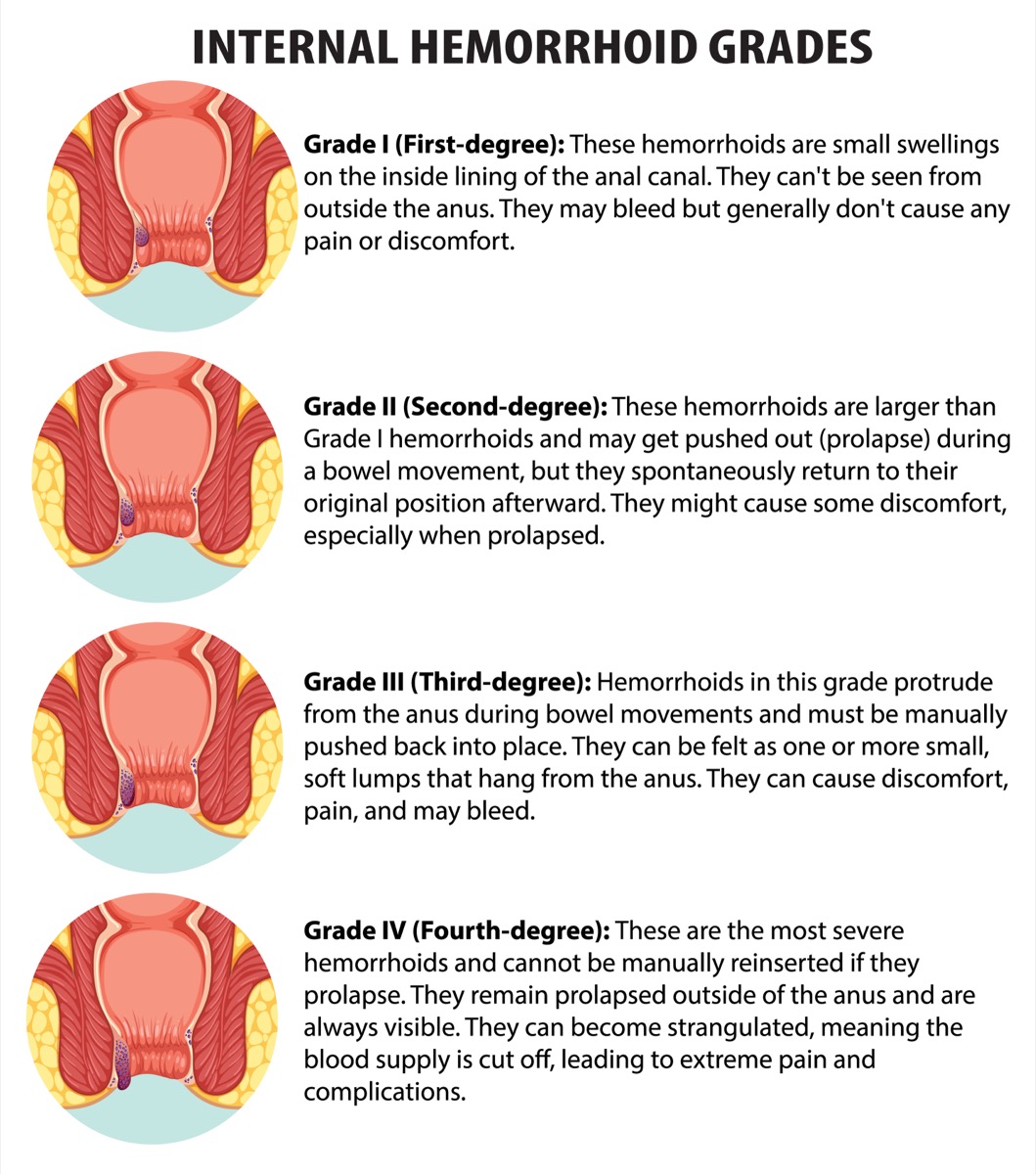 Chart showing internal hemorrhoid grades one through four